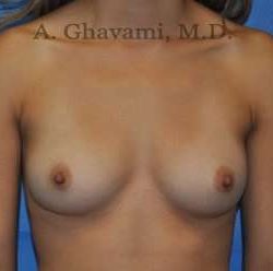 Breast Augmentation Before & After Patient #9046
