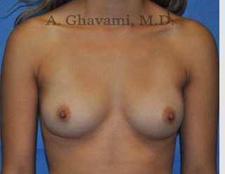 Breast Augmentation Before & After Patient #9046
