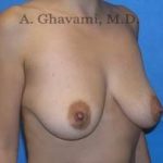Breast Lift Before & After Patient #8765