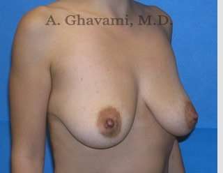 Breast Lift Before & After Patient #8765