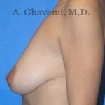 Breast Lift Before & After Patient #8765