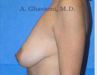 Breast Lift Before & After Patient #8765