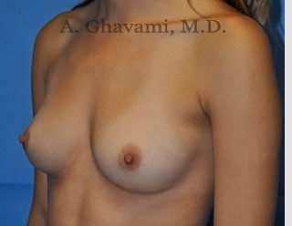 Breast Augmentation Before & After Patient #9046