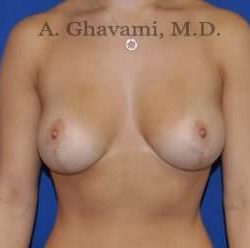 Breast Lift Before & After Patient #8758