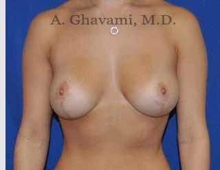 Breast Lift Before & After Patient #8758