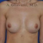 Breast Augmentation Before & After Patient #9039