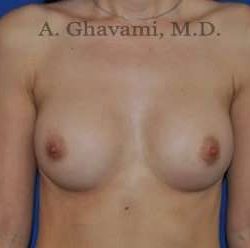 Breast Augmentation Before & After Patient #9039