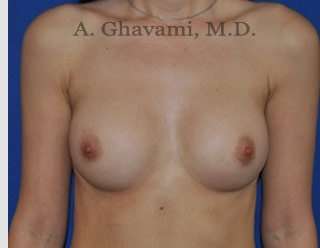 Breast Augmentation Before & After Patient #9039