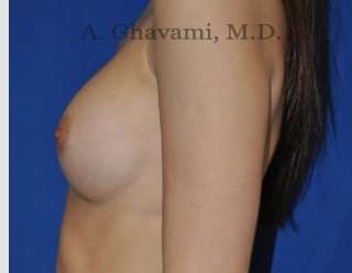 Breast Augmentation Before & After Patient #9039