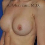 Breast Augmentation Before & After Patient #9039