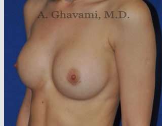Breast Augmentation Before & After Patient #9039