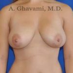 Breast Lift Before & After Patient #8758