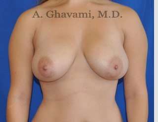 Breast Lift Before & After Patient #8758
