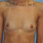 Breast Augmentation Before & After Patient #9039
