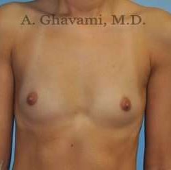 Breast Augmentation Before & After Patient #9039