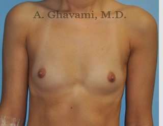 Breast Augmentation Before & After Patient #9039