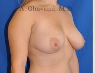 Breast Lift Before & After Patient #8758