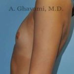 Breast Augmentation Before & After Patient #9039