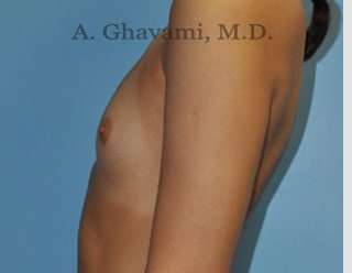 Breast Augmentation Before & After Patient #9039