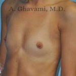 Breast Augmentation Before & After Patient #9039