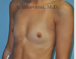 Breast Augmentation Before & After Patient #9039