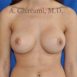 Breast Augmentation Before & After Patient #9032