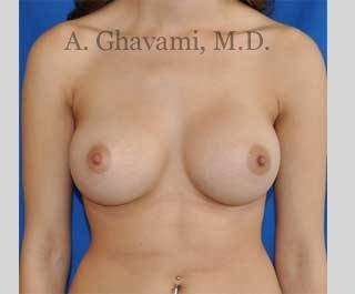 Breast Augmentation Before & After Patient #9032