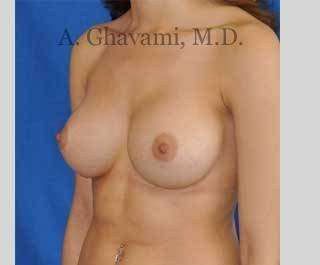 Breast Augmentation Before & After Patient #9032