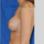 Breast Augmentation Before & After Patient #9032
