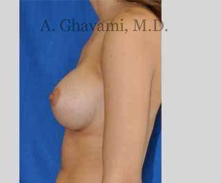 Breast Augmentation Before & After Patient #9032
