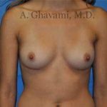 Breast Augmentation Before & After Patient #9032