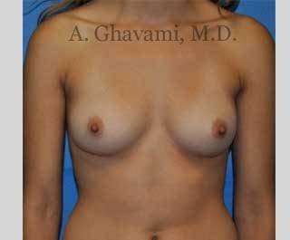 Breast Augmentation Before & After Patient #9032