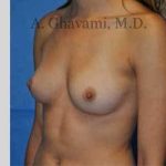 Breast Augmentation Before & After Patient #9032