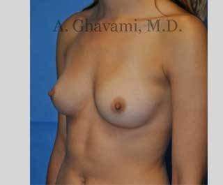 Breast Augmentation Before & After Patient #9032