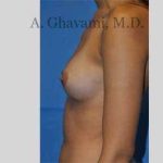 Breast Augmentation Before & After Patient #9032