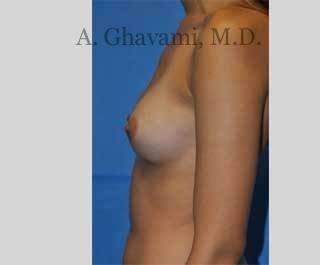 Breast Augmentation Before & After Patient #9032