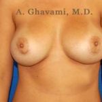 Breast Augmentation Before & After Patient #9025