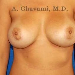 Breast Augmentation Before & After Patient #9025