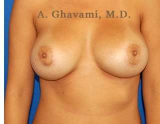 Breast Augmentation Before & After Patient #9025