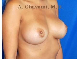 Breast Augmentation Before & After Patient #9025