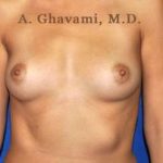 Breast Augmentation Before & After Patient #9025
