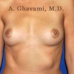Breast Augmentation Before & After Patient #9025