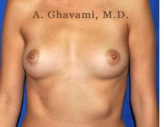 Breast Augmentation Before & After Patient #9025