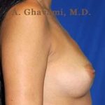 Breast Augmentation Before & After Patient #9025