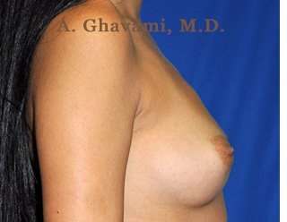 Breast Augmentation Before & After Patient #9025