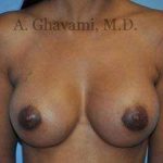 Breast Augmentation Before & After Patient #9018
