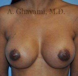 Breast Augmentation Before & After Patient #9018