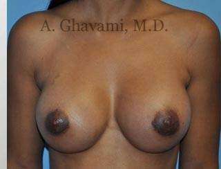 Breast Augmentation Before & After Patient #9018
