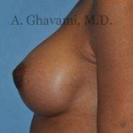 Breast Augmentation Before & After Patient #9018