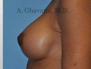Breast Augmentation Before & After Patient #9018